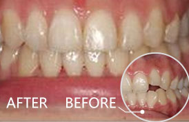 德国TM卓悦皓瓷牙--牙齿修复好选择