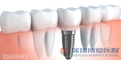 种植牙价格